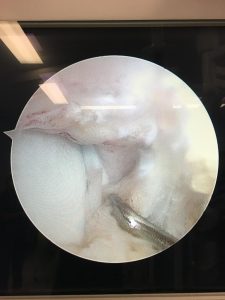 En la imagen puede verse el hueso de un tobillo mediante una intervención vía cirugía artroscópica